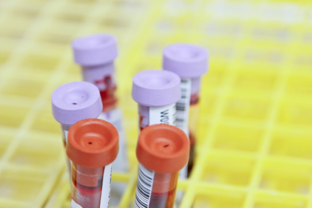 Does Alcohol Cause Anemia - Alt Text